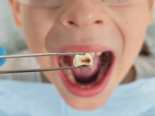 Best Emergency Tooth Extraction in Idalou, TX